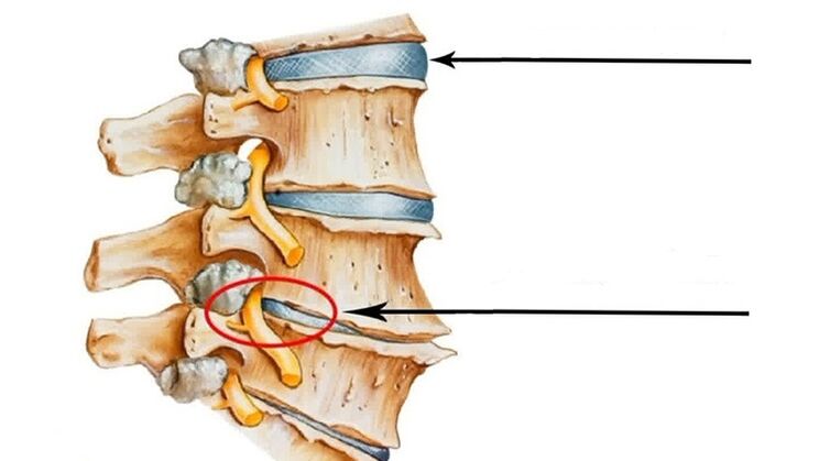 spinal cord injury in case of cervical osteochondrosis