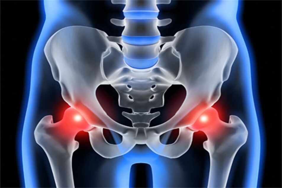 Deformative osteoarthritis of the hip joints (coxarthrosis)