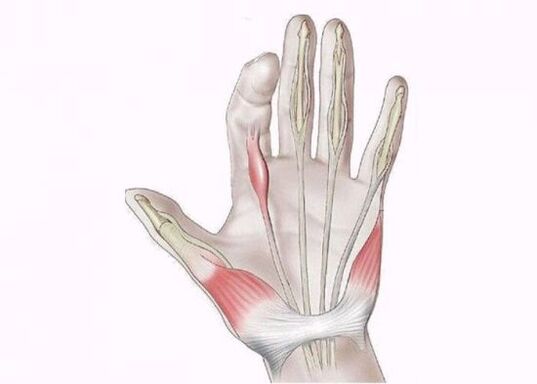 inflammation of tendons as a cause of pain in the joints of the fingers
