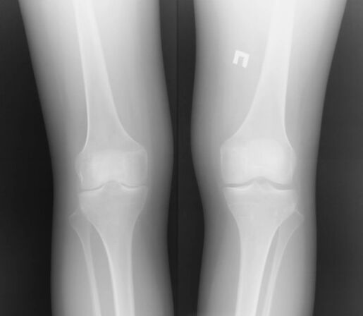 Radiographer of the knee joint