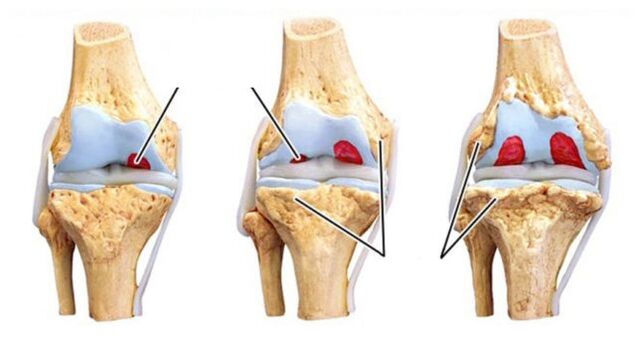 Complications of arthosis of the joints