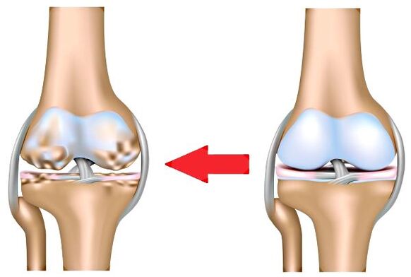 Healthy LED and Arthrosis