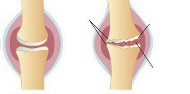 Wash cartilage