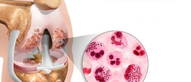 leading to the development of arthrosis