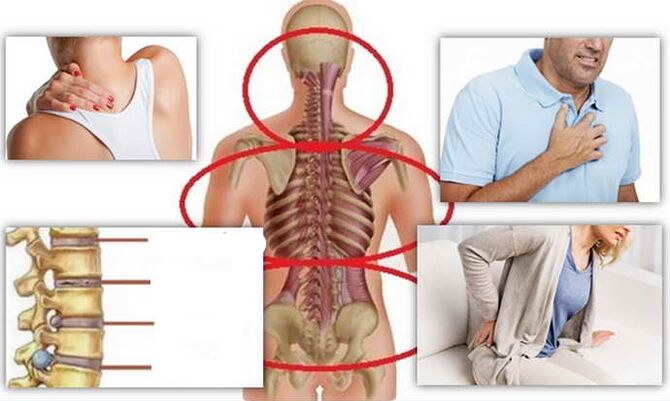 Disease sites for osteocondrosis