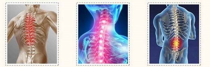 Osteochondrosis spinal cord lesions