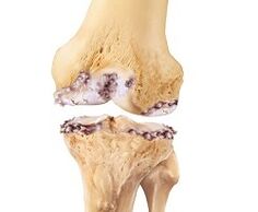 damage to the knee joint due to osteoarthritis