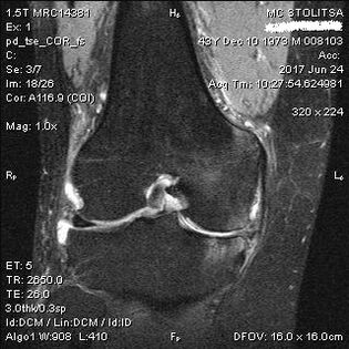Osteoarthritis in the knee joint on MRI